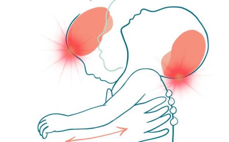 Le syndrome du bébé secoué, une des causes de mortalité infantile et des traumatismes chez les nourrissons