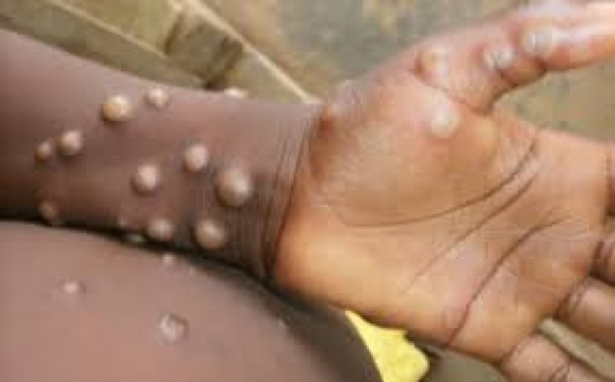 RDC : Au moins 15 664 cas de Monkeypox notifiés en RDC, dont 548 décès