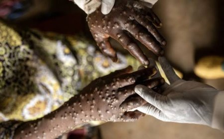 Nord-Kivu : alerte sur une maladie au MPOX Mpox dans la prison de Beni